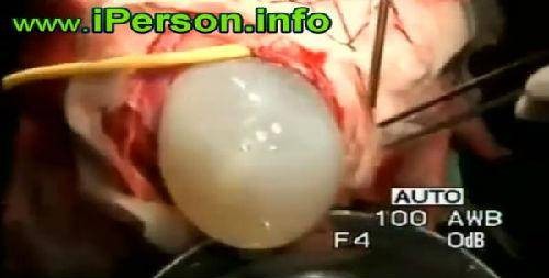 吃脑寄生虫