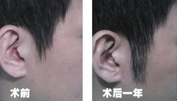 鬓角移植特点