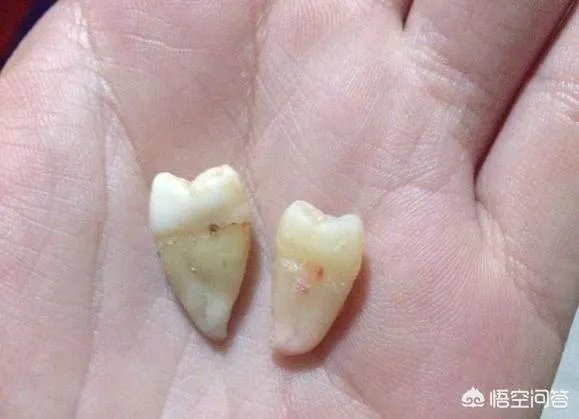 拔智齿真的可以瘦脸吗?有何依据?