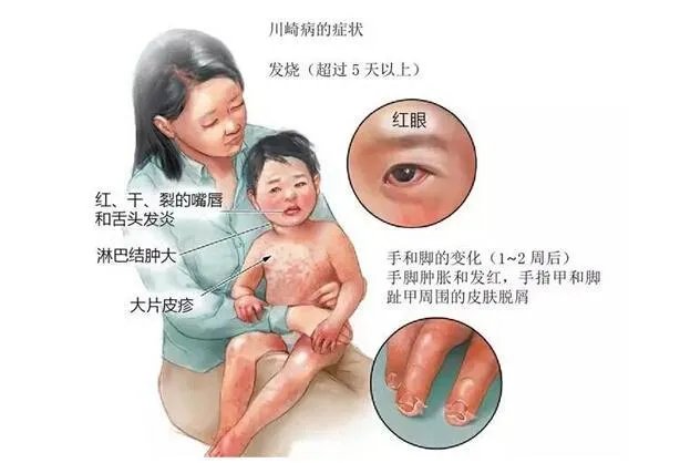 如何看待英国多个重症监护病房儿童身上出现罕见病,是新冠出现变异了么?