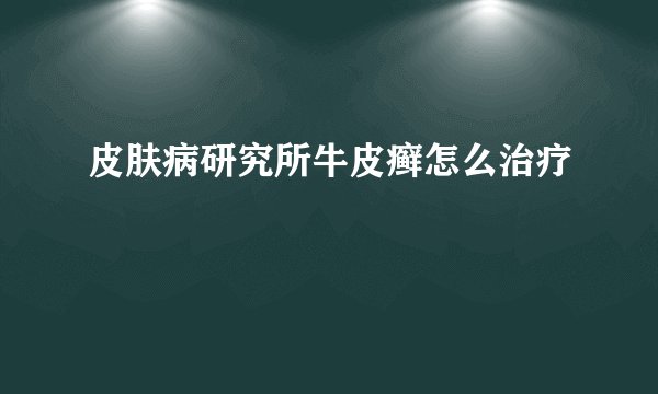 皮肤病研究所牛皮癣怎么治疗