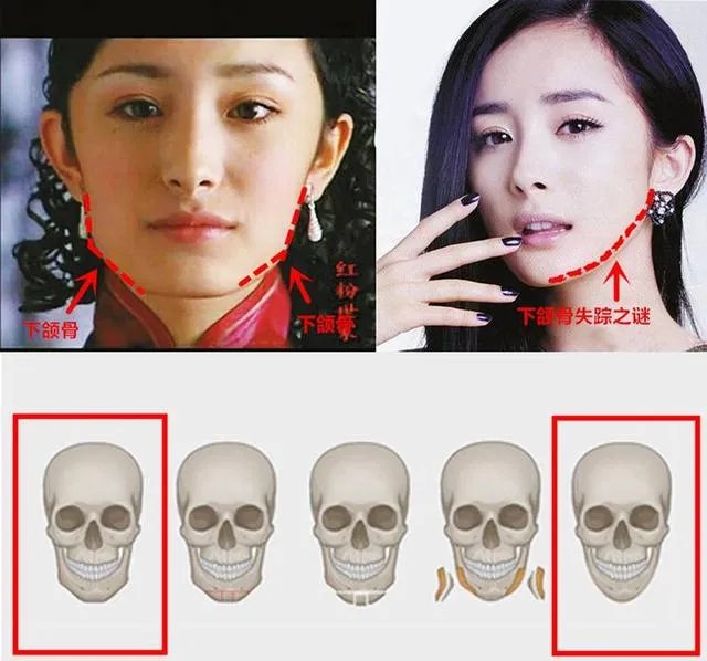 拔智齿真的可以瘦脸吗?有何依据?