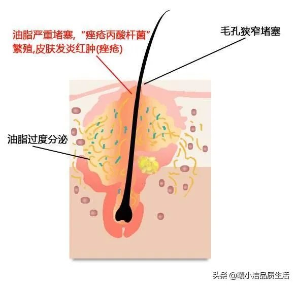 有没有真的适合痘痘肌的平价护肤品?