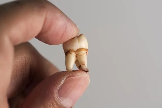 拔智齿真的可以瘦脸吗?有何依据?