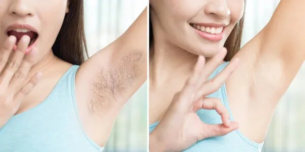 明星都是怎么脱毛的