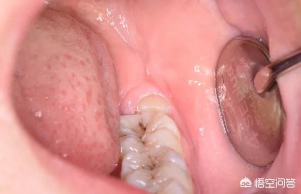 拔智齿真的可以瘦脸吗?有何依据?