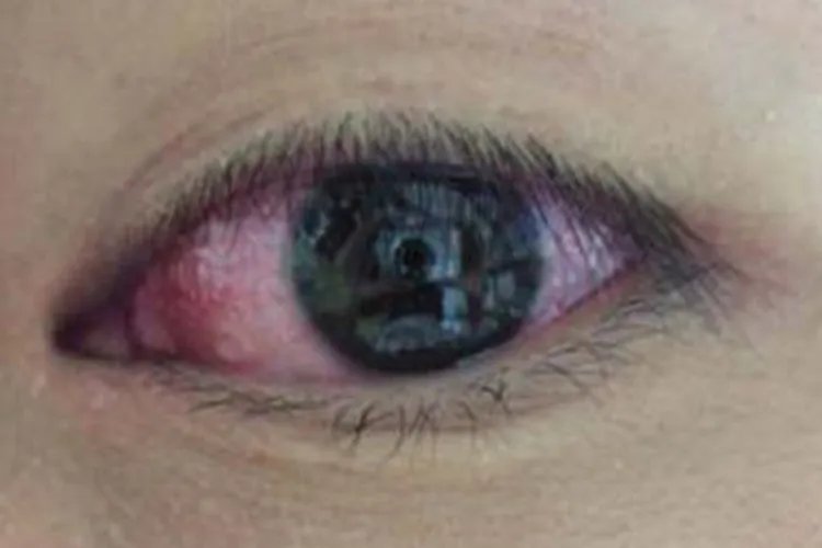 婴儿麻疹的症状图片