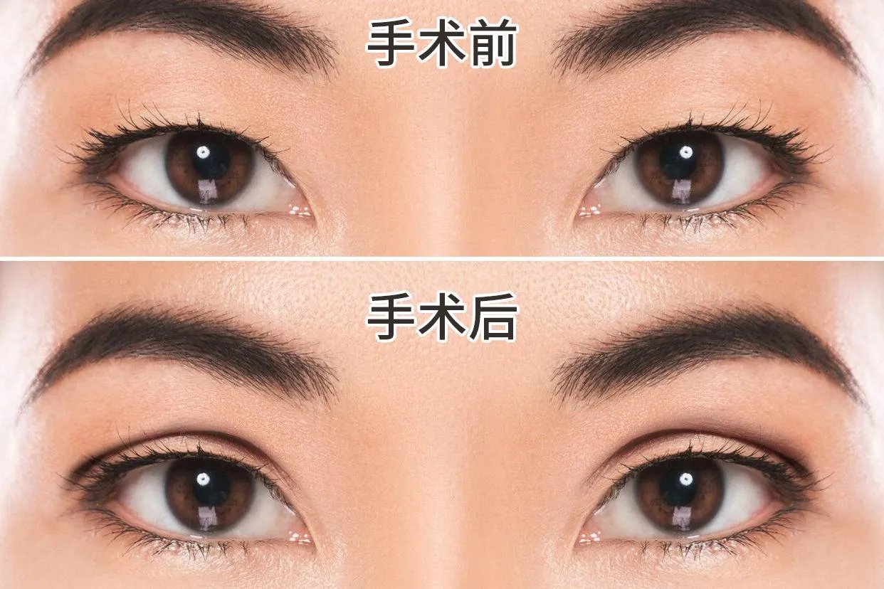全切双眼皮图片