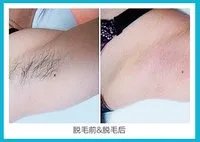 激光脱毛全身多少钱