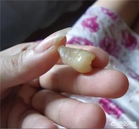 拔智齿真的可以瘦脸吗?有何依据?
