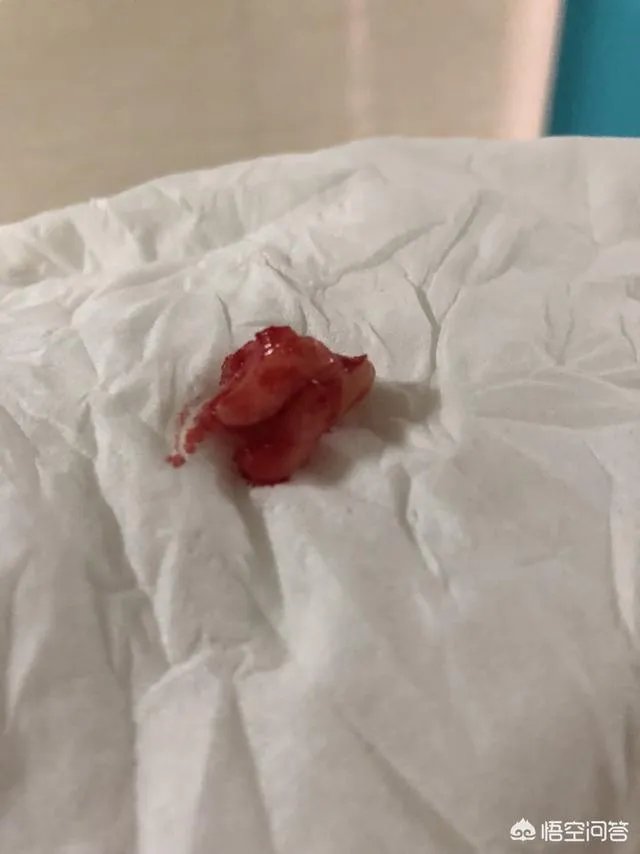 拔智齿真的可以瘦脸吗?有何依据?