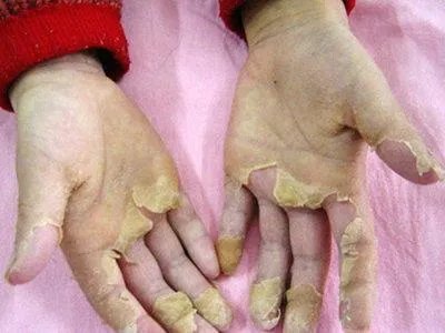 如何看待英国多个重症监护病房儿童身上出现罕见病,是新冠出现变异了么?
