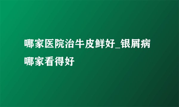 哪家医院治牛皮鲜好_银屑病哪家看得好