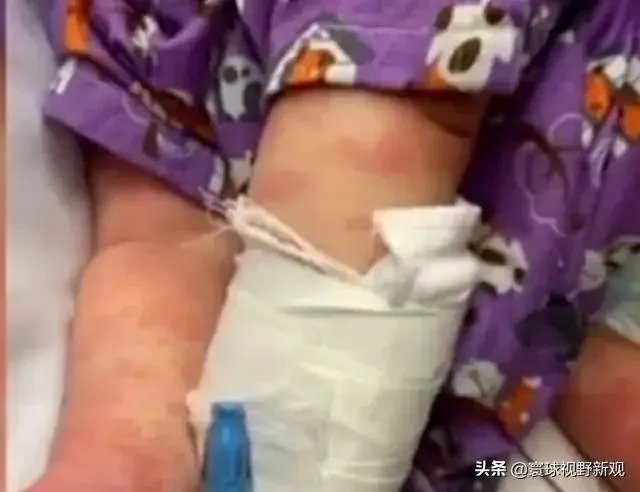 如何看待英国多个重症监护病房儿童身上出现罕见病,是新冠出现变异了么?