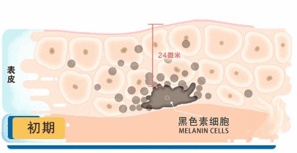 美容院的仪器祛斑有用吗