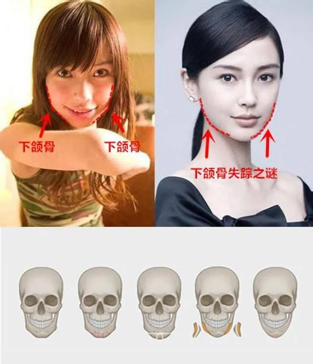 拔智齿真的可以瘦脸吗?有何依据?