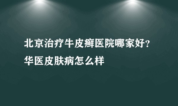北京治疗牛皮癣医院哪家好？华医皮肤病怎么样